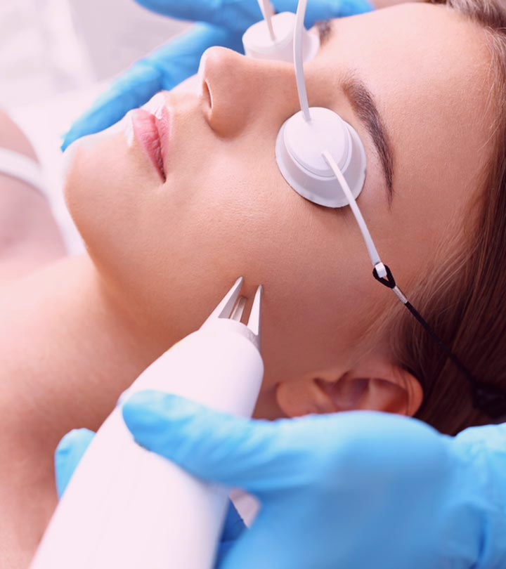 Laser Acne Scars